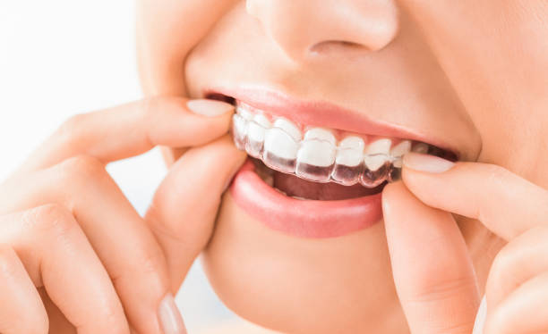 Achieve a Perfect Smile with Invisalign in West Covina