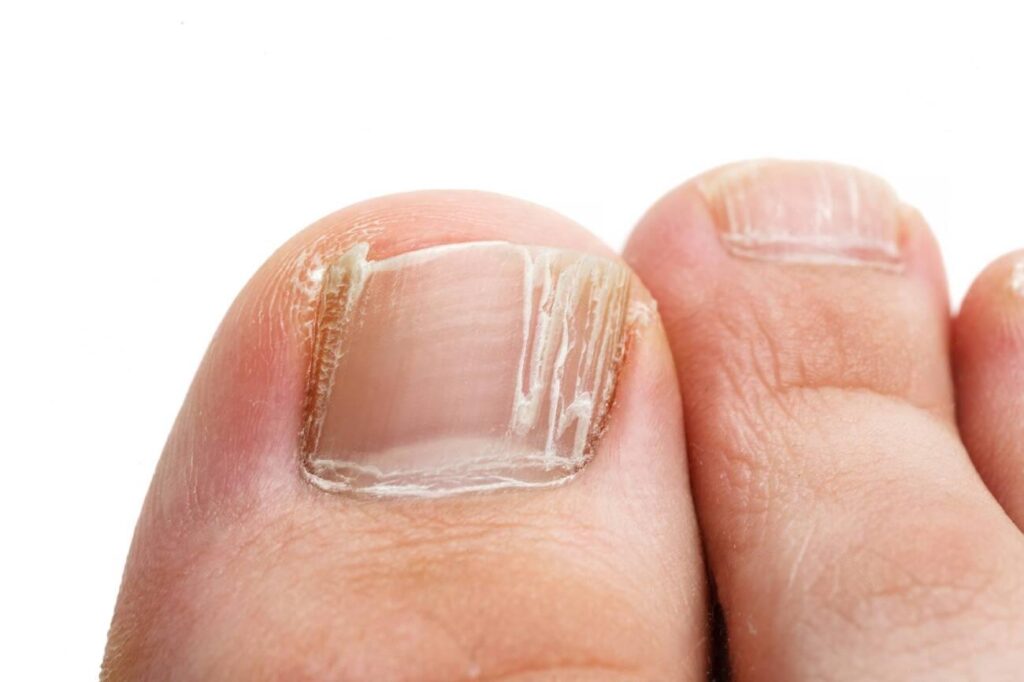 Nutritional Deficiencies and Cracked Toenails