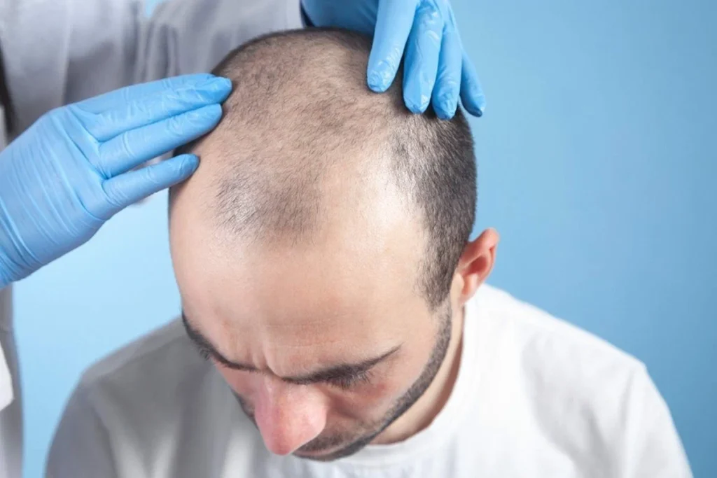Understanding FUE vs. FUT in Dubai Hair Transplants