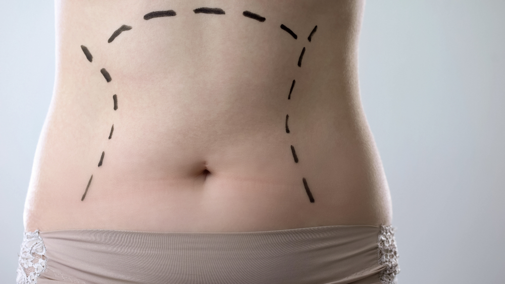The Dubai Advantage: Why Liposuction is Revolutionizing Body