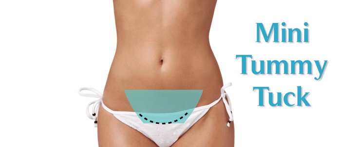 Dubai Mini Tummy Tuck: Cost & Benefits