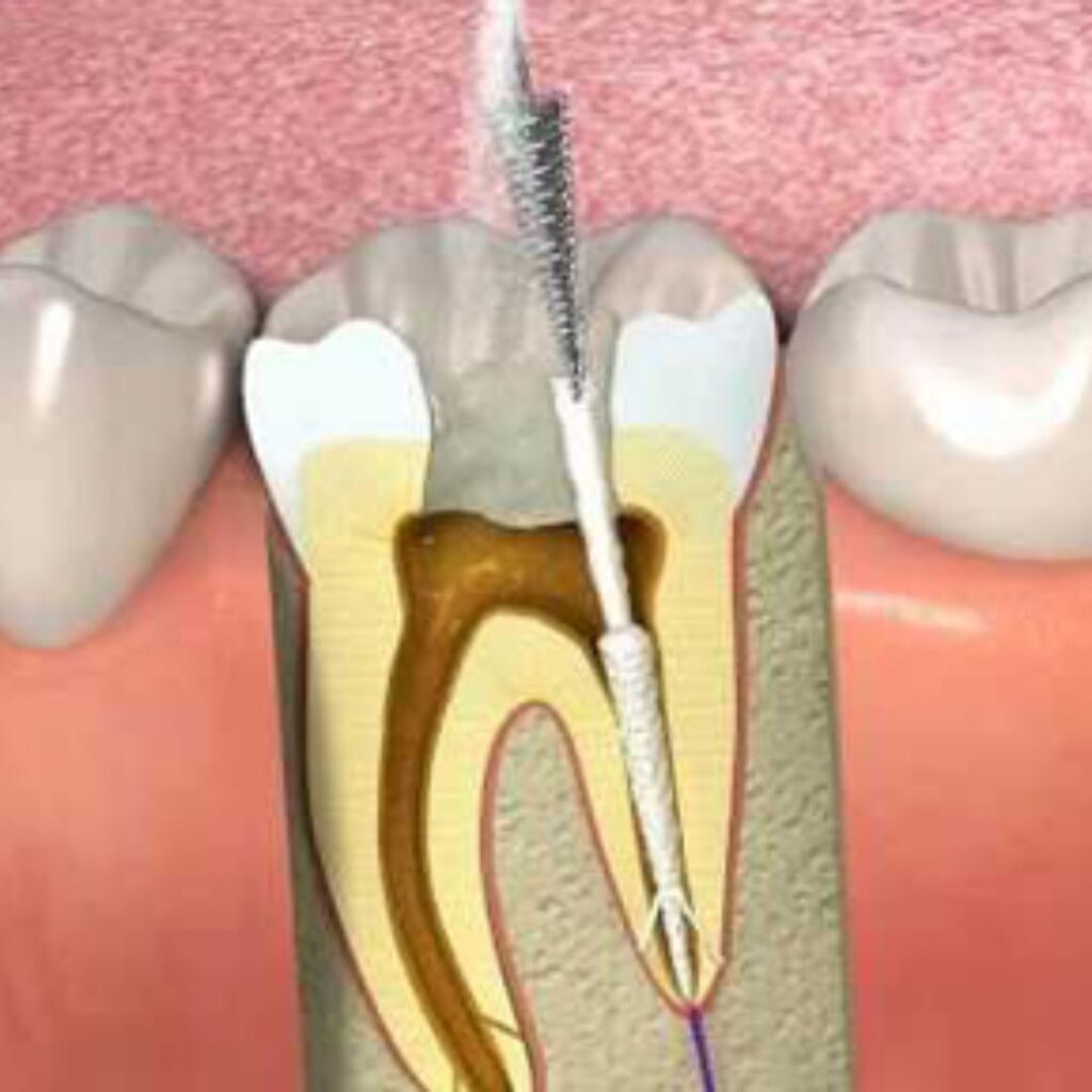 Experience Painless Root Canal Treatment in Vasant Kunj