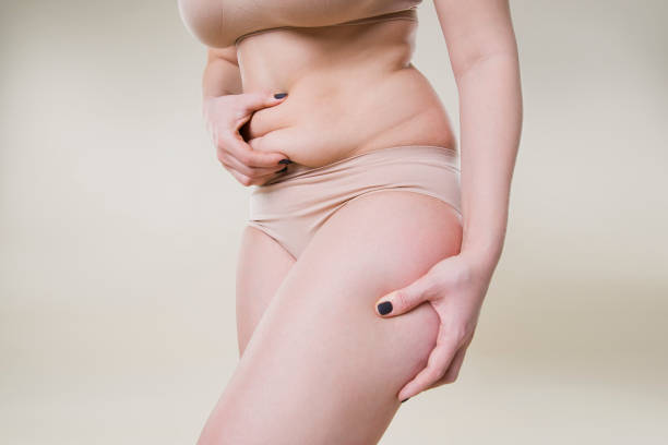 Mini Tummy Tuck Dubai: Your Ultimate Aesthetic Guide