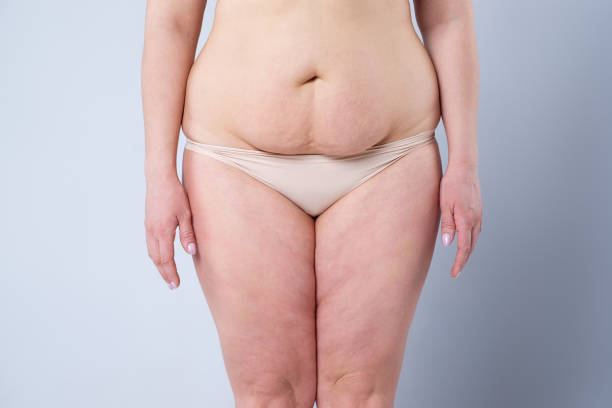 Dubai Tummy Tuck: Redefine Your Look With Care