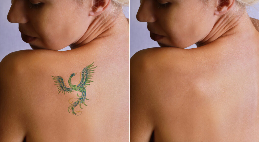 How Laser Tattoo Removal Works on Multi-Colored Ink Tattoos