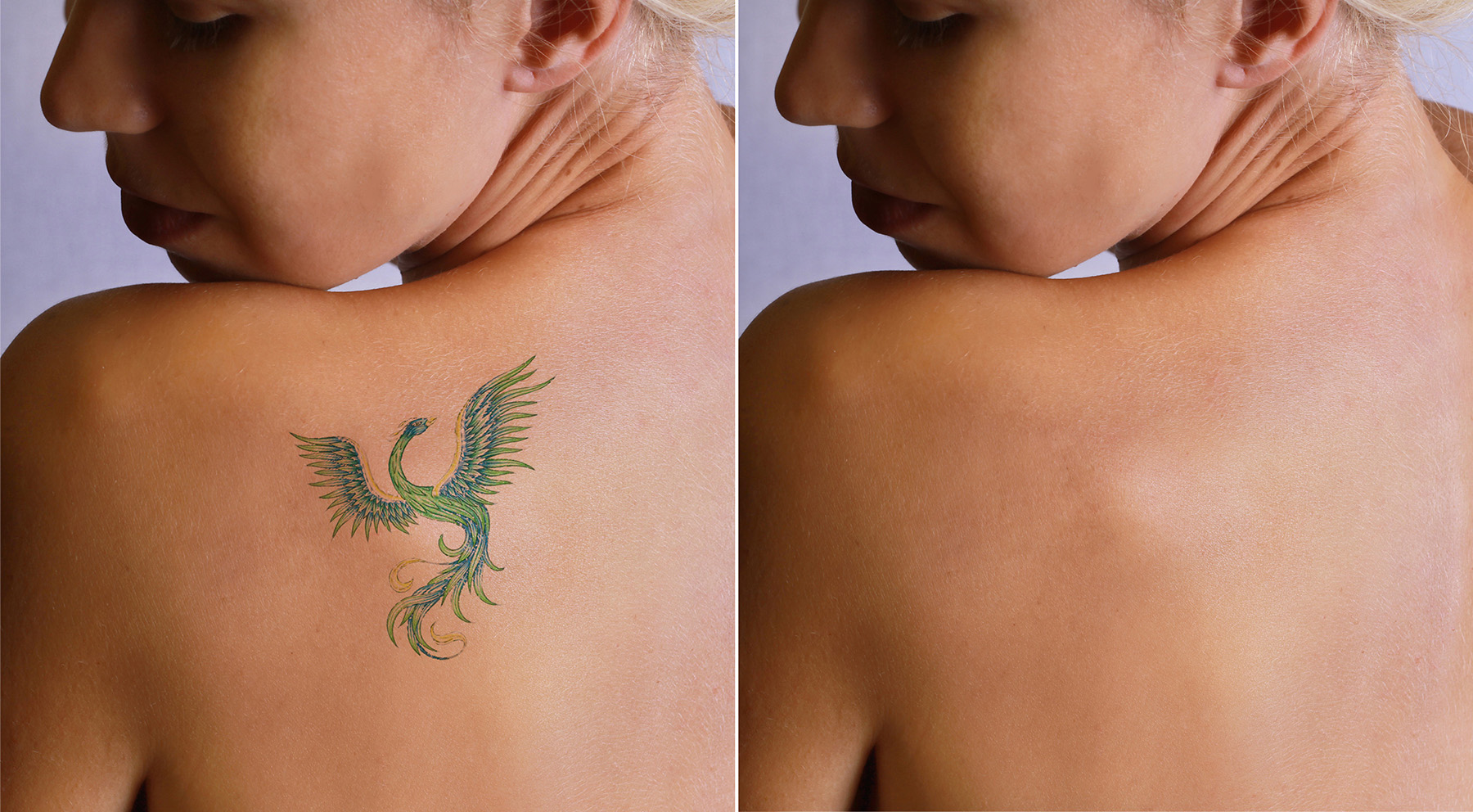 How Laser Tattoo Removal Works on Multi-Colored Ink Tattoos
