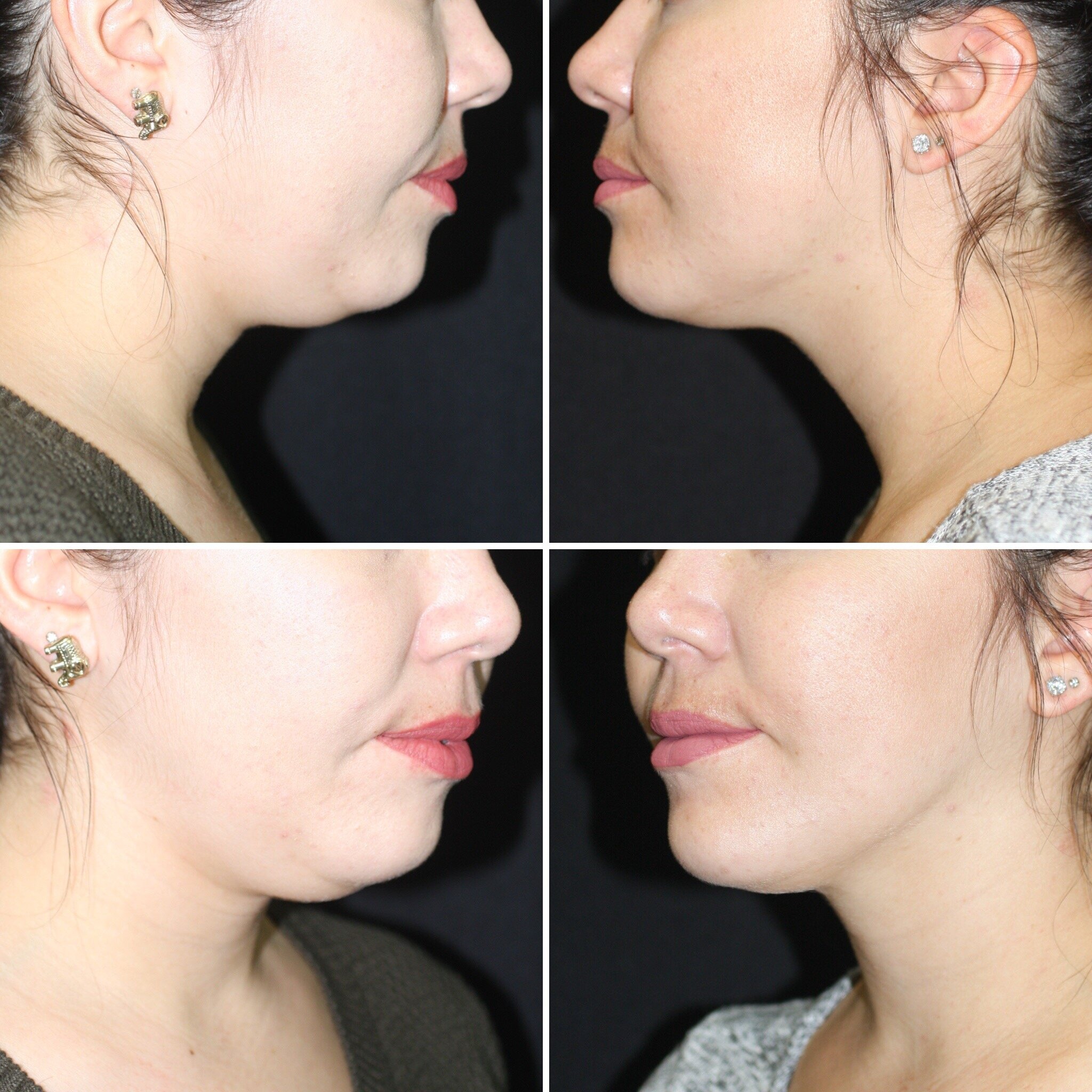 Who Is a Candidate for Double Chin Liposuction?