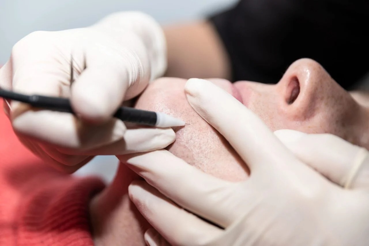 Electrolysis Laser Hair Removal explained