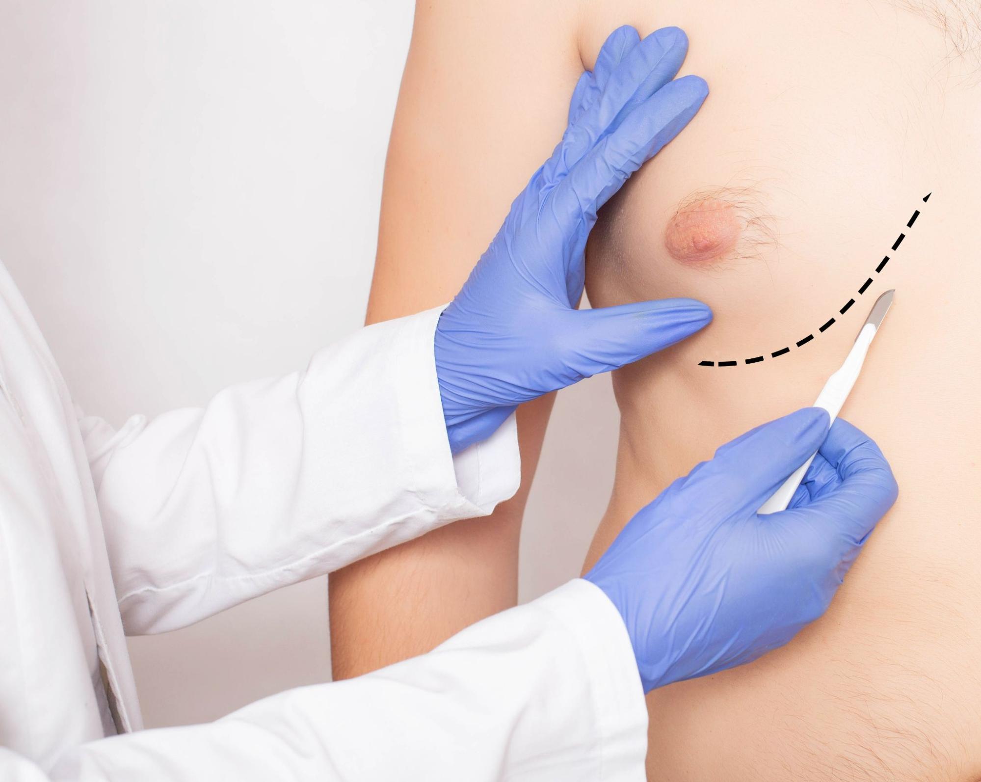 The Medical vs. Aesthetic Side of Gynecomastia Treatment