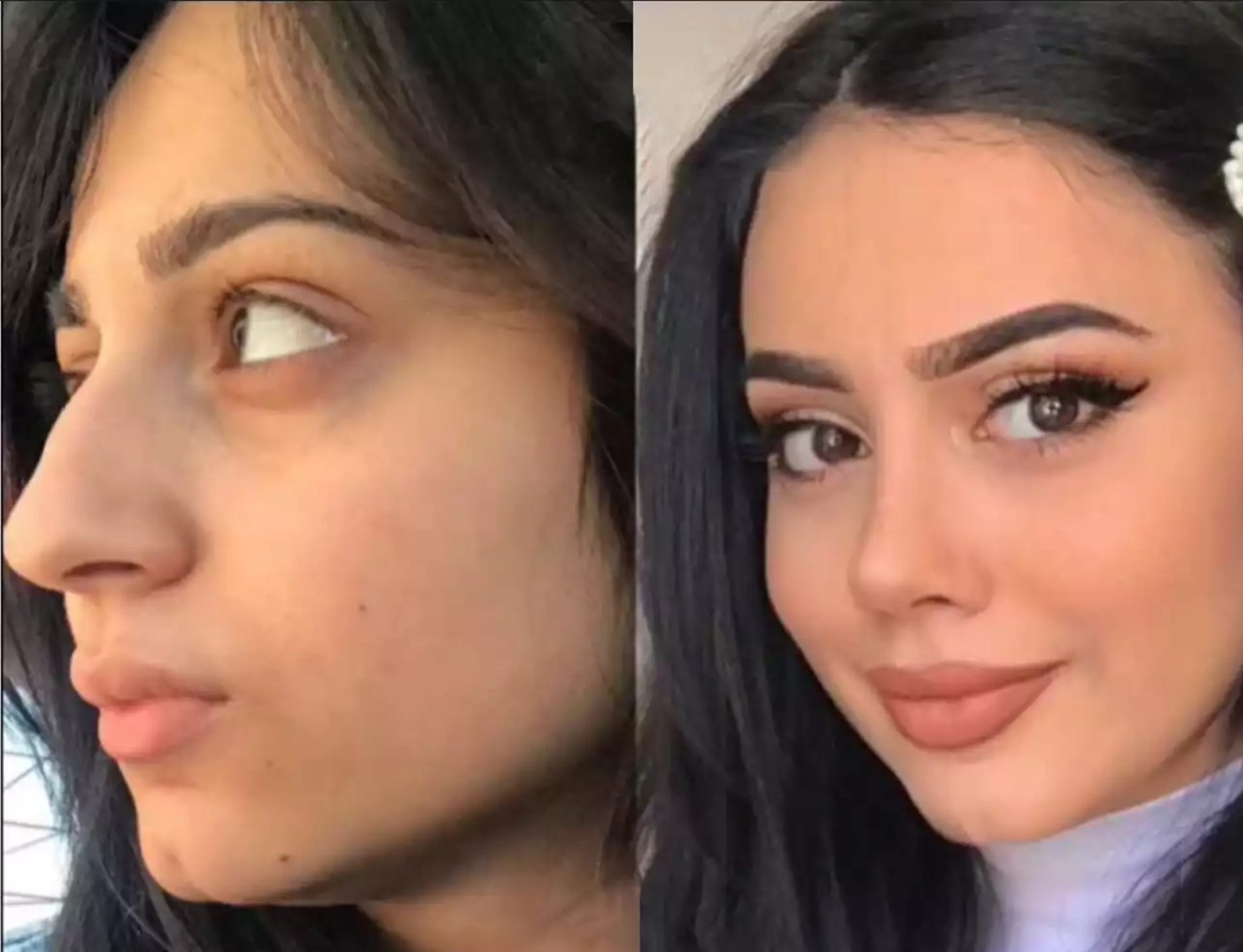 Traits That Define the Best Rhinoplasty Surgeon in Dubai
