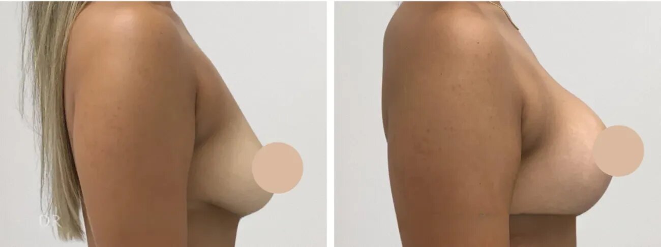 What Happens If You Don’t Follow Post-Op Care Instructions After Breast Lift Surgery in dubai?