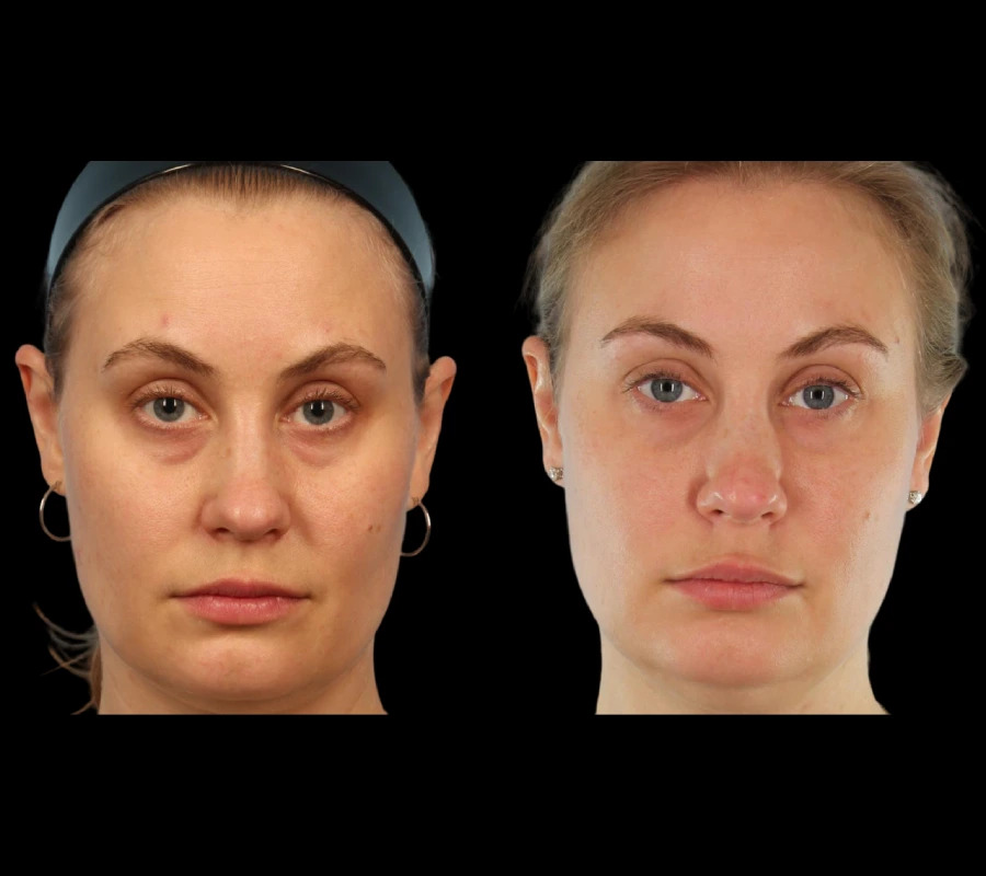 Under Eye Fillers Look at Best Aesthetic Clinic in Dubai