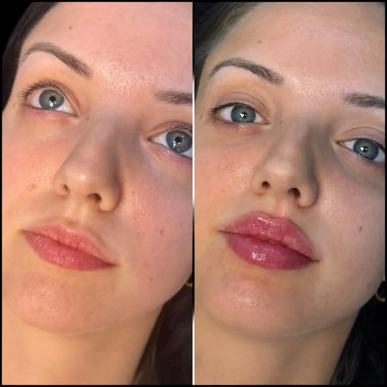 Why Best Aesthetic Clinic in dubai is Perfect for fillers