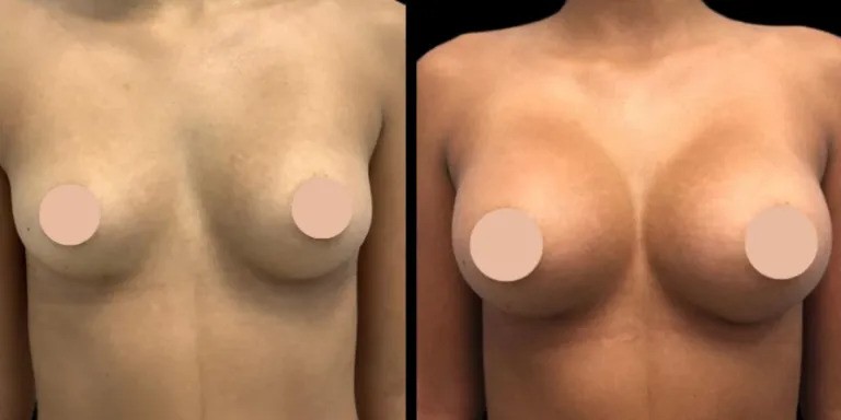 Natural Looking Best Breast Augmentation surgeons in Dubai