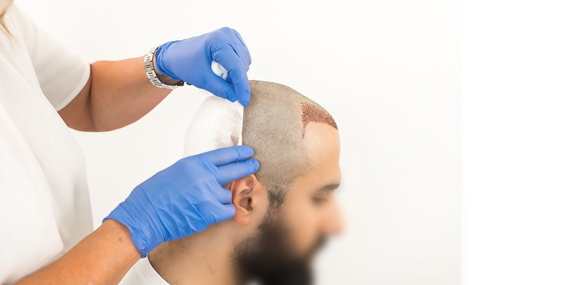 How Many Hair Transplant Sessions Might I Need?