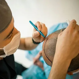 Ne5 Myths About Hair Transplant in Islamabad Debunkedw Post
