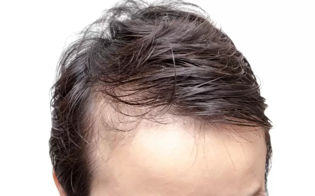 Is Front Line Hair Fixing permanent?
