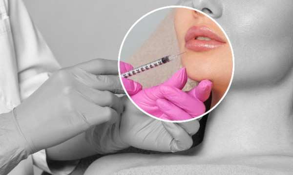 All the Essential Info About Lip Fillers You’re Seeking