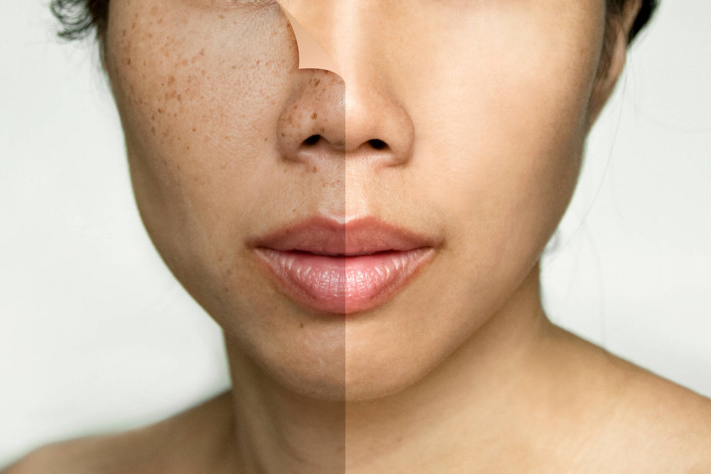 Considering Chemical Peels for Melasma: Pros and Cons