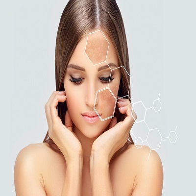 Understanding the Root Causes of Melasma in Women and Men