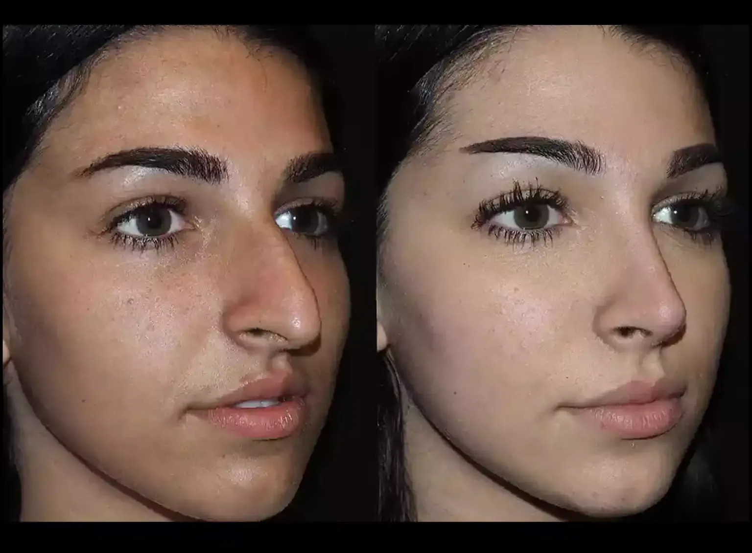 Septoplasty with the Best Septoplasty Surgeon in Dubai
