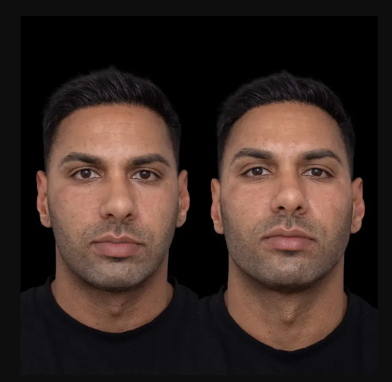 Sculptra Fillers Treatments in Dubai for Men: Growing Trend