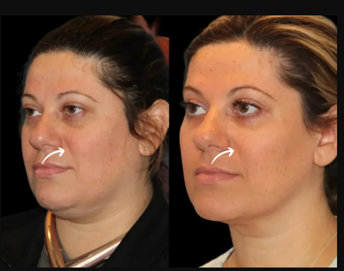 Are Dubais Best Doctors: Experts in Sculptra Fillers Tech