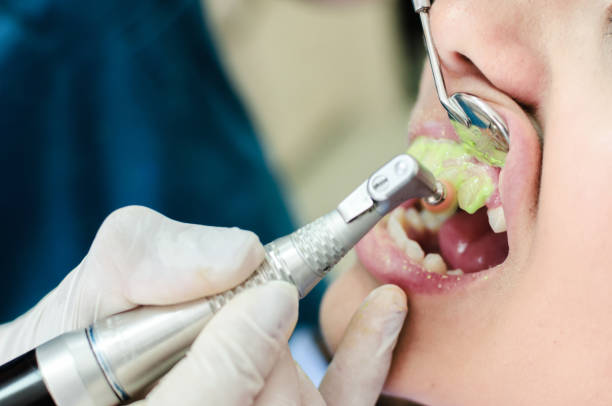 How to Get Polished Teeth in Riyadh