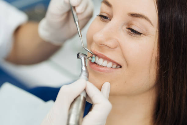 The Connection Between Teeth Cleaning and Polishing and Fre