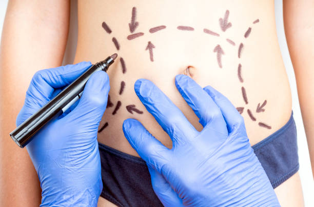 Tummy Tuck in Riyadh: Before and After Results