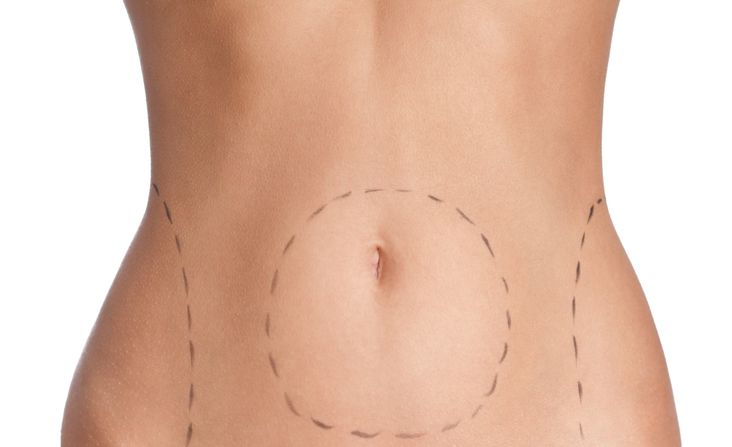 Is Tummy Tuck in Riyadh Right for You?