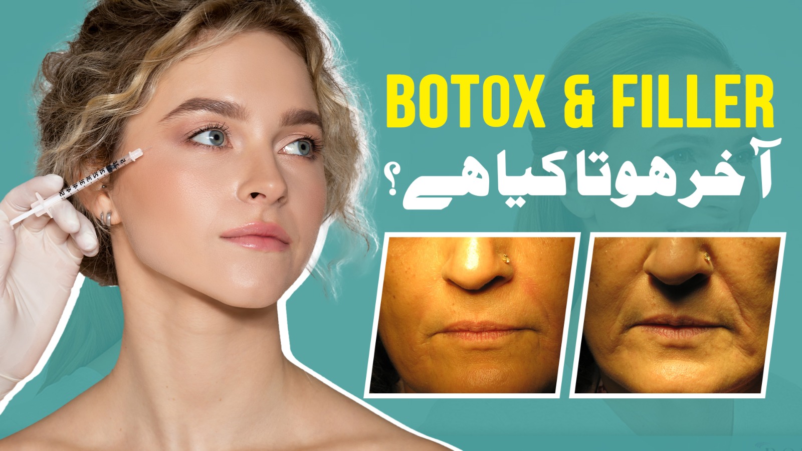 Natural Botox & Fillers in Pakistan