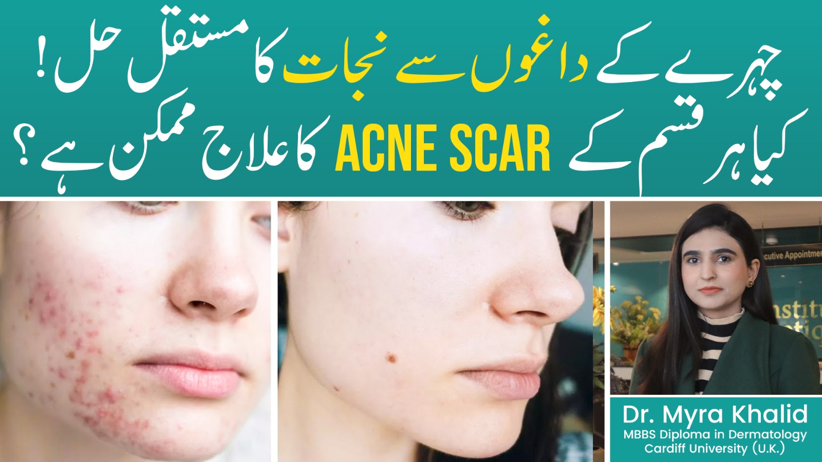 Say Goodbye to Scars: Top Acne Scar Solutions That Work