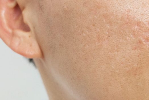 How to Maintain Your Skin After a Good Acne Treatment