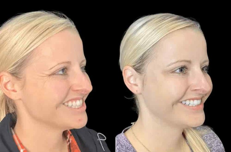 Enhance Your Facial Features with Botox Treatments in Dubai