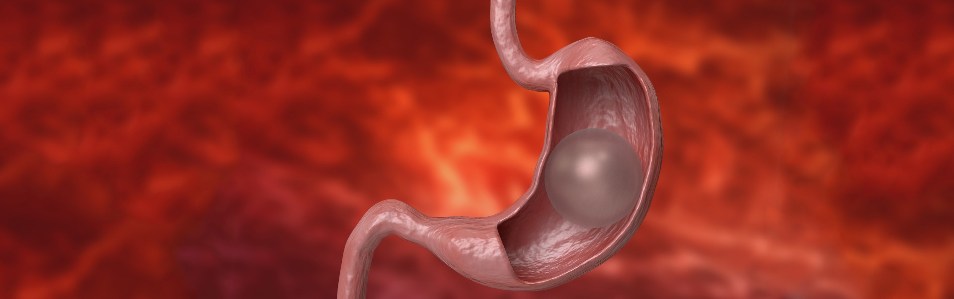 Gastric Balloon Placement for Weight