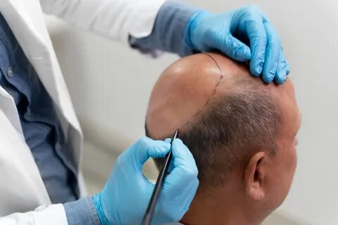 What to Expect Before and After a Hair Transplant